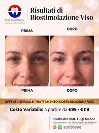 Biostimolazione, filler, botox, labbra, rinofiler
