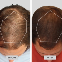 Cappello Laser Terapia Luce Rossa Capelli