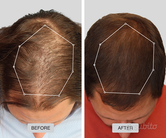 Cappello Laser Terapia Luce Rossa Capelli