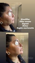 PROMO BOTOX e FILLER