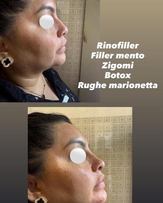 PROMO BOTOX e FILLER
