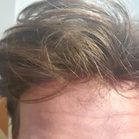 Patch Cutanea + Montaggio Low-Cost Garantito