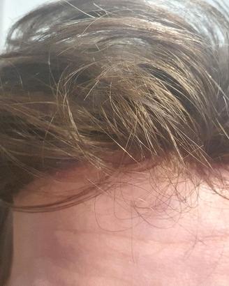 Patch Cutanea + Montaggio Low-Cost Garantito